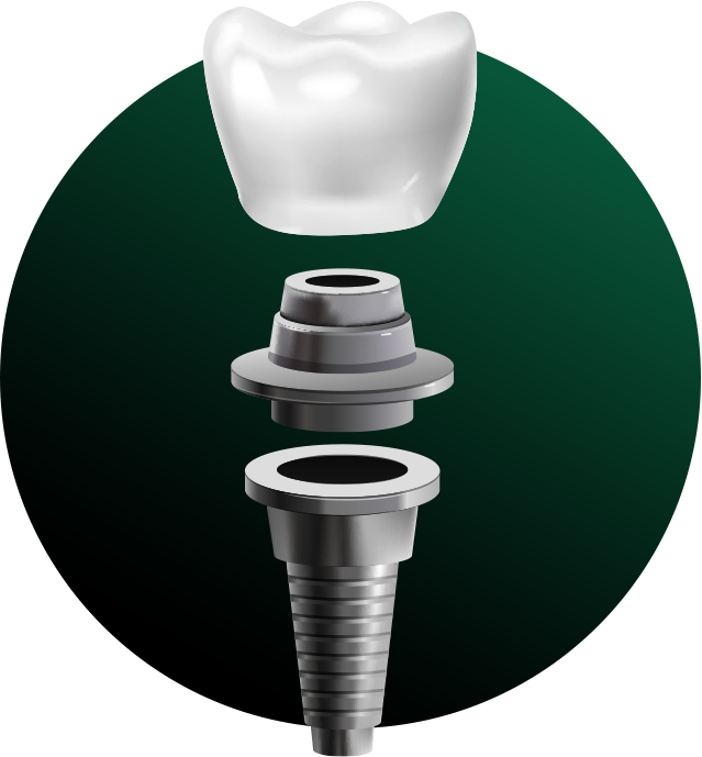 DENTAL IMPLANTS