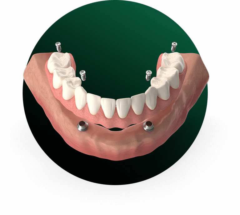 HYBRID DENTURES