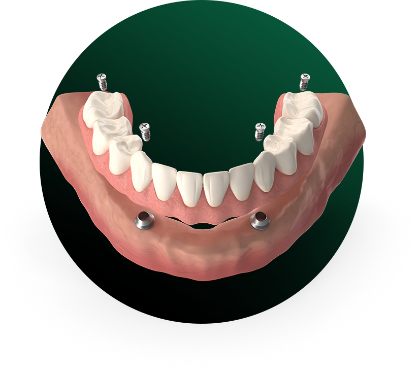HYBRID DENTURES