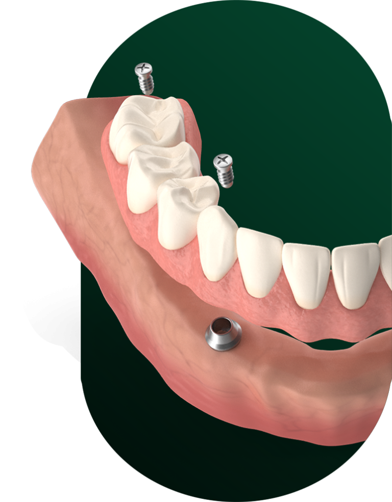implant supported denture