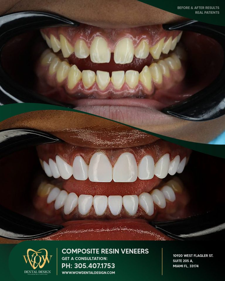 wow-composite-resin (1)