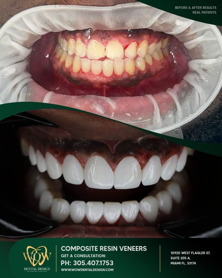 wow-composite-resin (2)