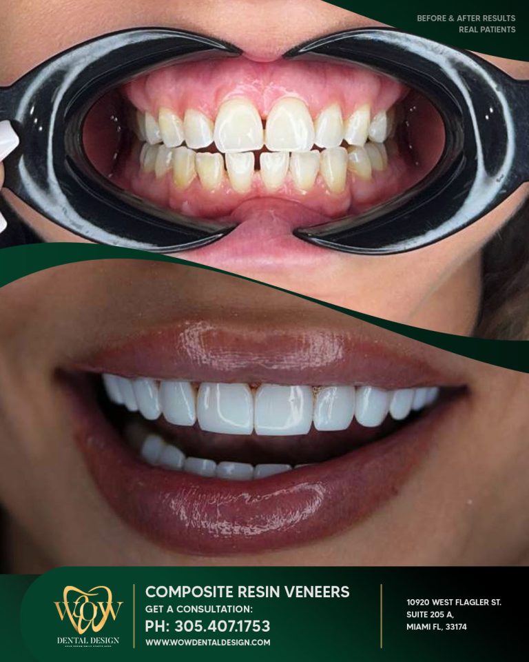 wow-composite-resin (3)