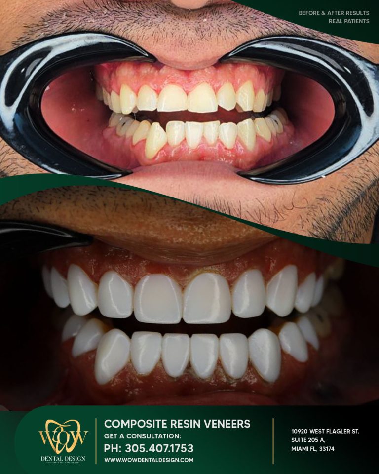 wow-composite-resin (4)