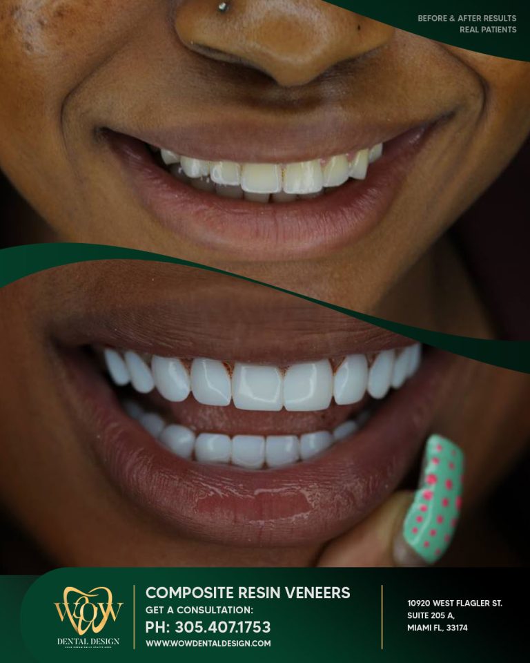 wow-composite-resin (5)