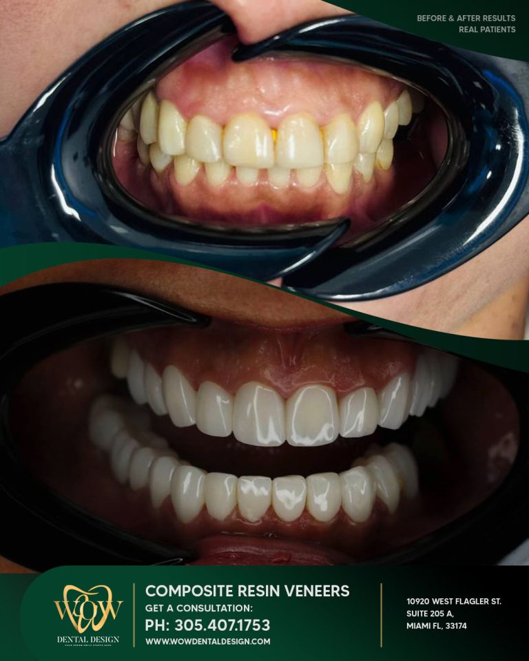 wow-composite-resin (6)